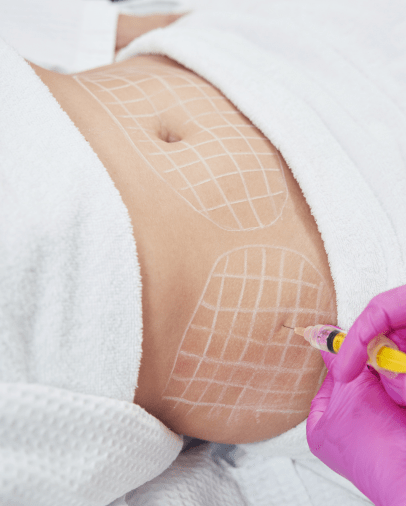 Fat-away injection injection lipolysis